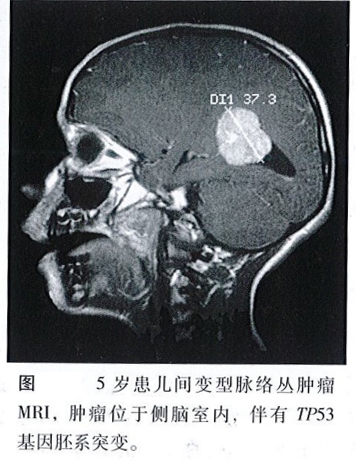 脈絡(luò)叢腫瘤有哪些