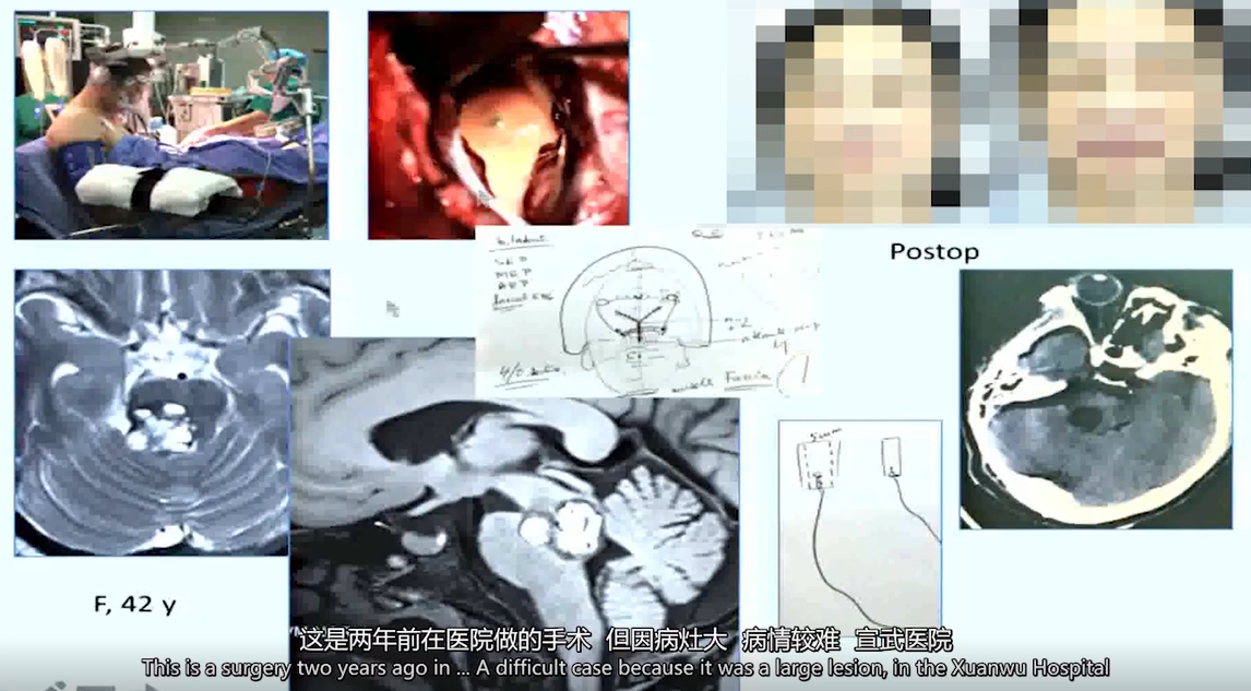腦干海綿狀血管瘤