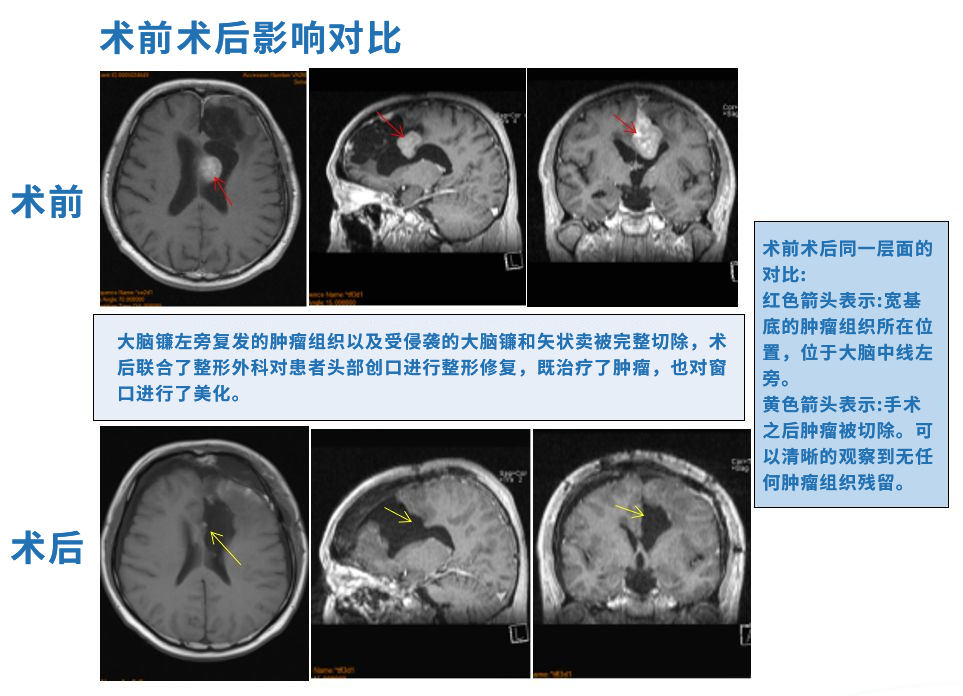 多發(fā)性腦膜瘤怎么治療？