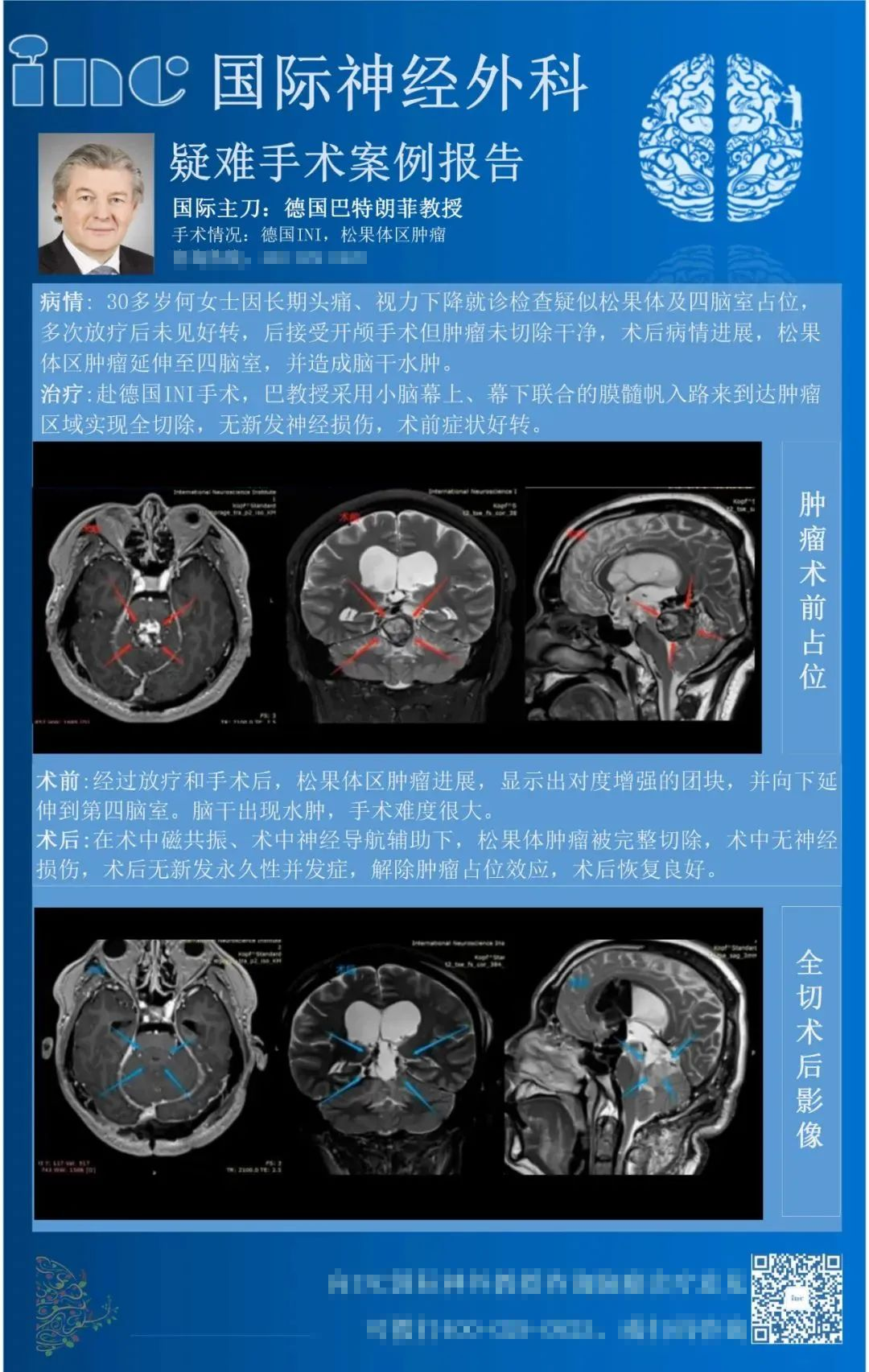 松果體區(qū)腫瘤