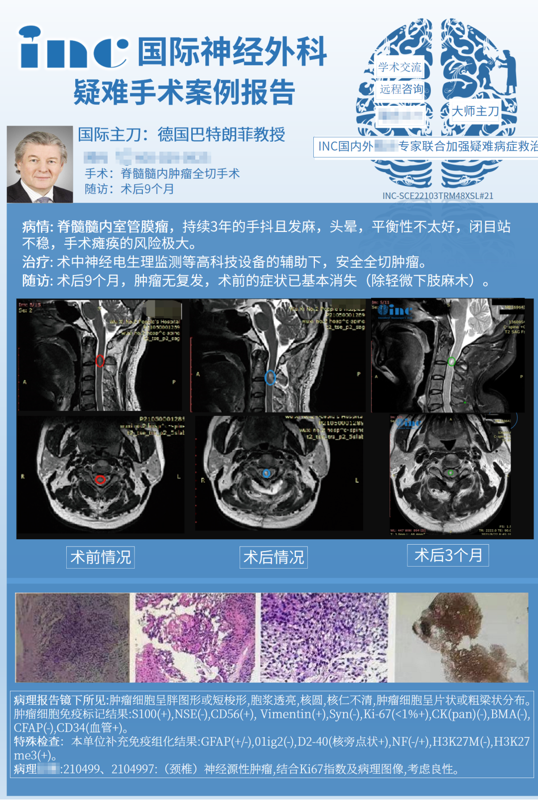 脊髓室管膜瘤生存期有多久？脊髓室管膜瘤真實患者案例交流