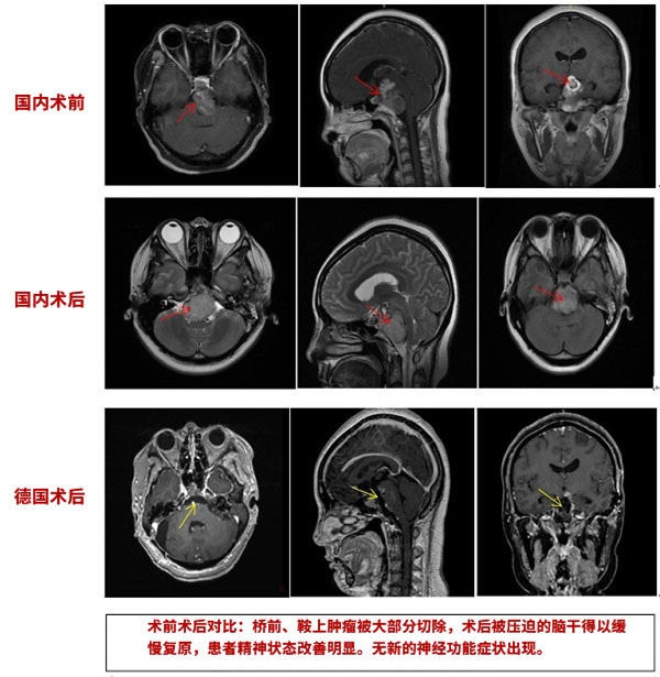 脊索瘤能完全治愈嗎