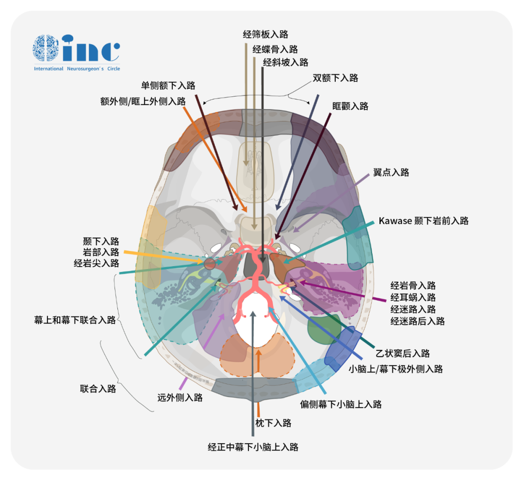 顱底腦膜瘤