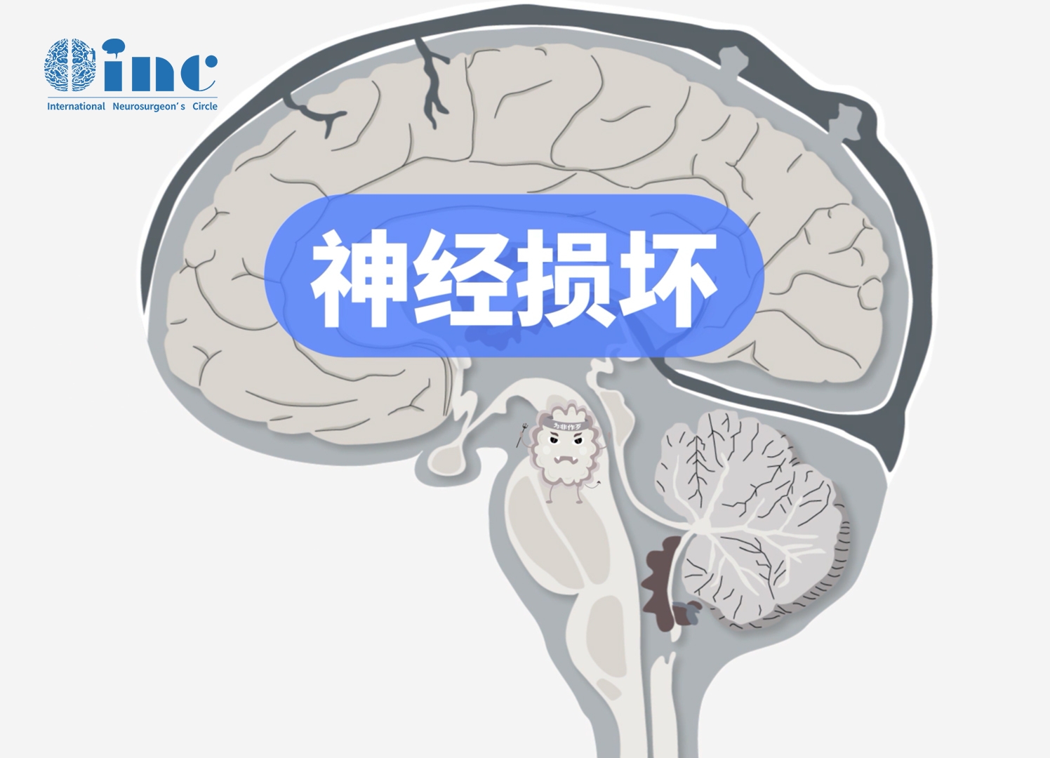 腦干膠質(zhì)瘤手術(shù)