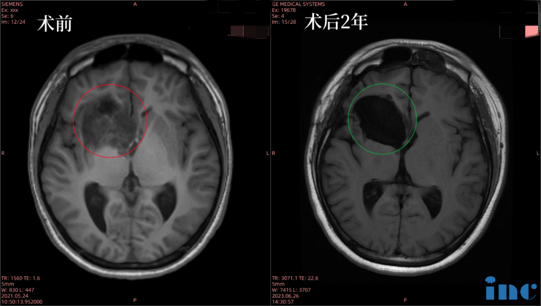 16歲男孩--右側(cè)額葉、島葉膠質(zhì)瘤