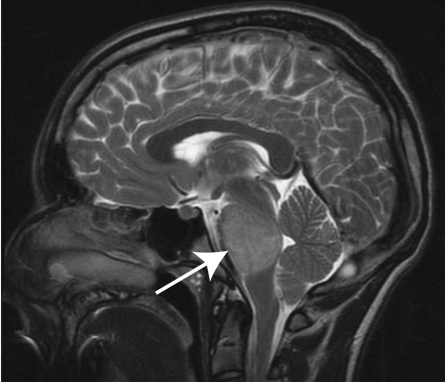 圖1：T2加權(quán)矢狀面（DIPG）兒童腦部MRI