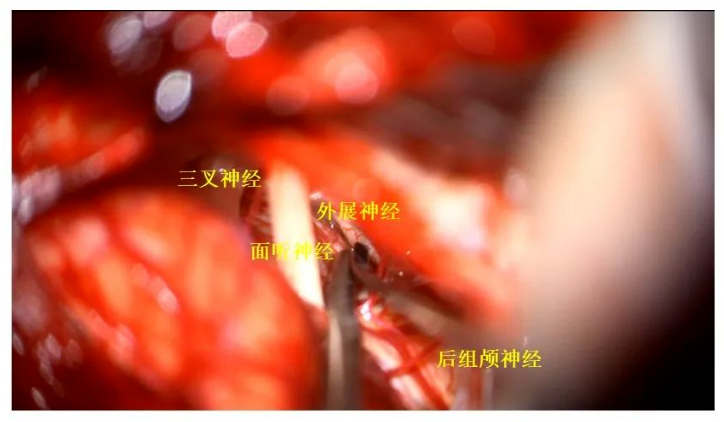 三叉神經(jīng)、面聽神經(jīng)、外展神經(jīng)、后組神經(jīng)保護(hù)完好
