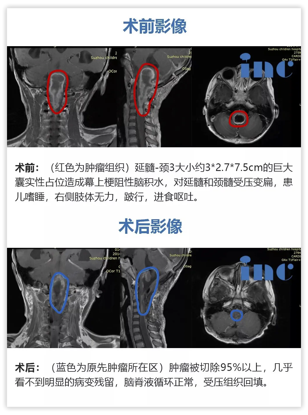 5歲女孩——脊髓-腦干毛細(xì)胞星形細(xì)胞瘤影像圖片