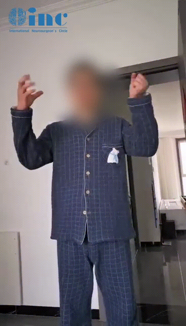 32歲男性-腦干延髓海綿狀血管瘤真實(shí)案例