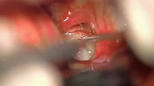 使用cusa進行腫瘤大部分減容