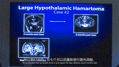 James T. Rutka教授曾通過LITT治療過一位四歲的下丘腦錯(cuò)構(gòu)瘤癲癇患兒