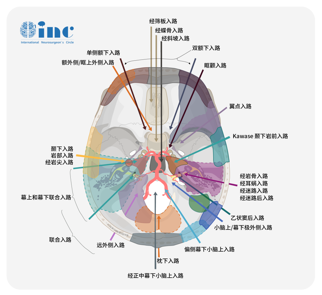 手術(shù)入路的選擇：ILSA or 顳下入路