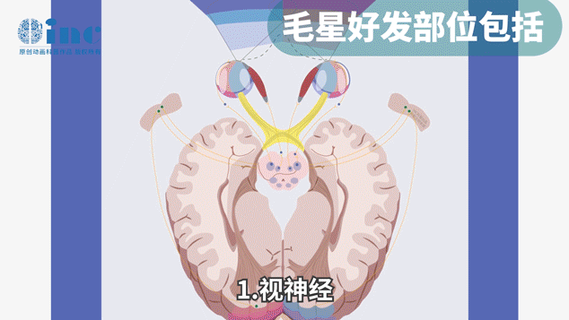 良性低級別膠質(zhì)瘤（pediatric low-grade glioma, PLGG）