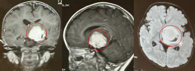 面對(duì)多數(shù)兒童腦腫瘤，手術(shù)往往是能夠徹底清除病灶、為孩子贏得生存希望的治療手段。