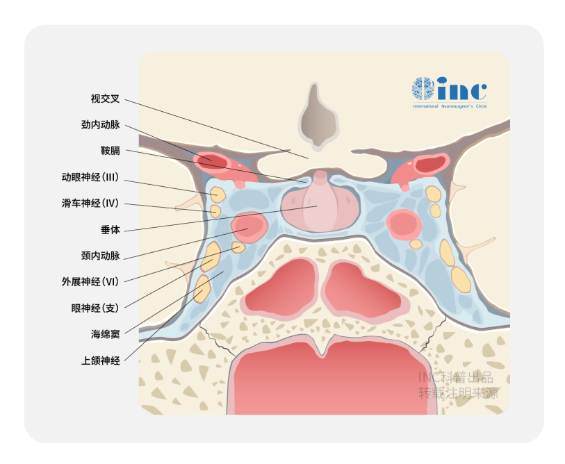 INC國際三大教授關(guān)于海綿竇腦膜瘤開顱內(nèi)鏡手術(shù)進展