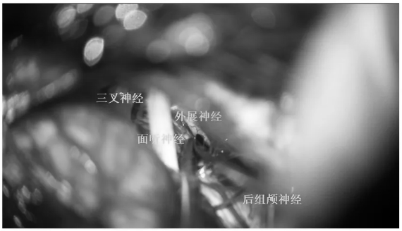 三叉神經(jīng)、面聽神經(jīng)、外展神經(jīng)、后組神經(jīng)保護(hù)完好