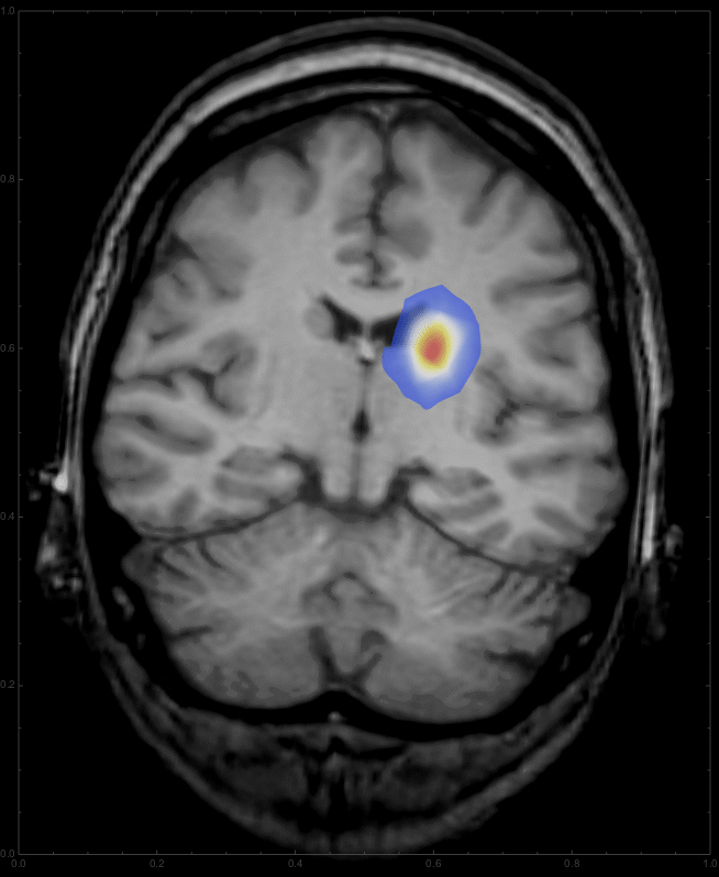<a href='/naoliu/' target='_blank'><u>腦腫瘤</u></a>生長(zhǎng)擴(kuò)散動(dòng)態(tài)演示圖