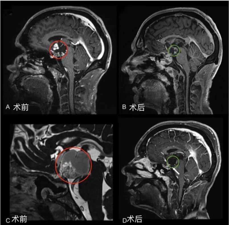 35歲男性視盲、認(rèn)知下降竟是巨大顱咽管瘤，INC福教授全切術(shù)后即明顯好轉(zhuǎn)