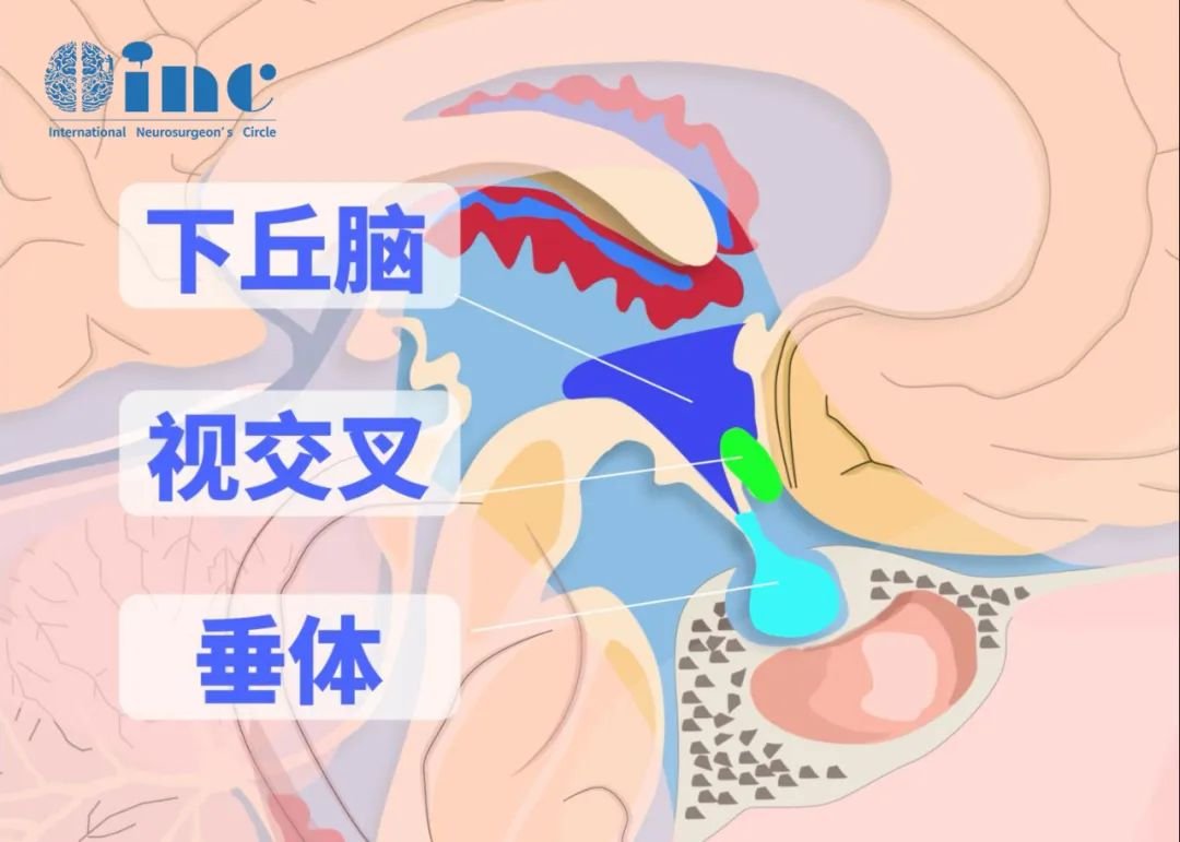 垂體瘤卒中是選擇手術(shù)還是保守治療？