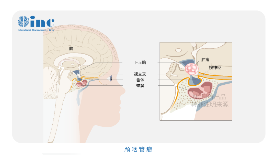 正值壯年卻被巨大顱咽管瘤纏上，安全全切能阻止復(fù)發(fā)嗎？