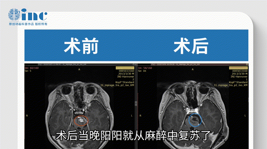 術后當晚陽陽就從麻醉中復蘇了，神志清楚，思路清晰，四肢活動自如，術后第2天遷出ICU，回到普通病房和父母團聚;
