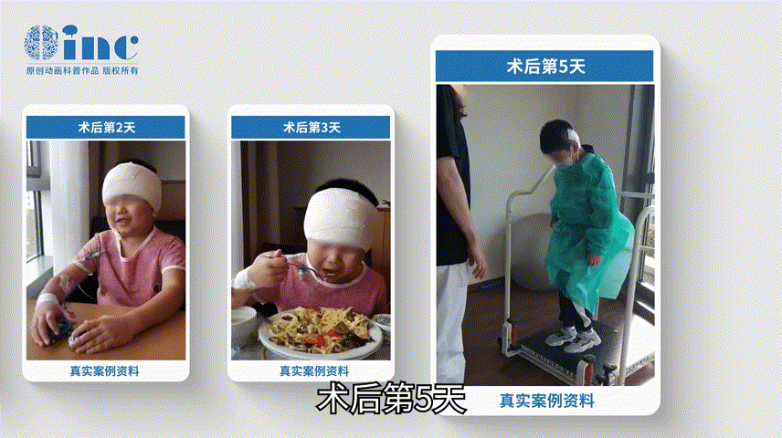術后第3天，可自行持筷用餐。術后第5天，能在護士的照顧下獨立行走，進行康復鍛煉。術后第8天還未拆線，陽陽就順利出院回國了。