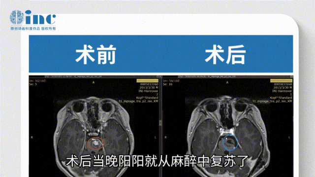 在術后回訪中，陽陽已經活動自如，可以正常生活，有自理能力，并且恢復了原來的活潑好動。