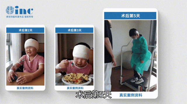在術后回訪中，陽陽已經活動自如，可以正常生活，有自理能力，并且恢復了原來的活潑好動。