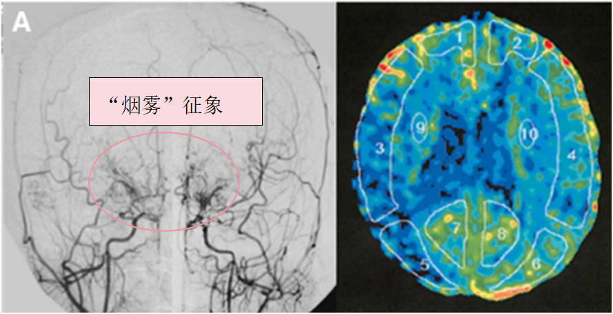 術(shù)前血管造影(雙側(cè)頸總動(dòng)脈正位圖)顯示雙側(cè)頸內(nèi)動(dòng)脈末端有“煙霧血管狹窄征象”，雙側(cè)大腦中動(dòng)脈(MCA)狹窄(左)。術(shù)前Xe-CT顯示雙側(cè)MCA區(qū)域腦血流減少(右)