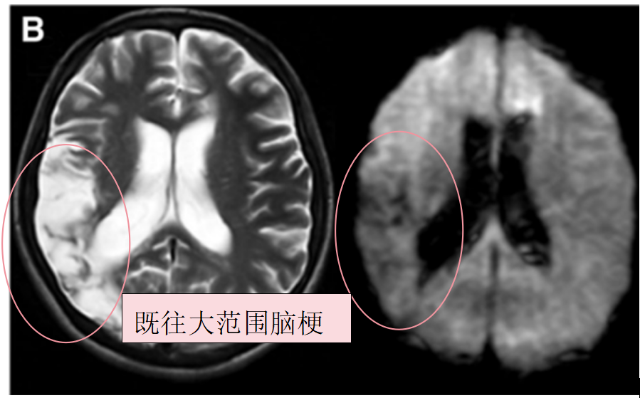 術(shù)前T2、DWI序列顯示入院前1個(gè)月顯示，既往右側(cè)額頂葉腦梗死