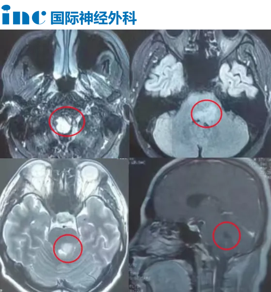 腫瘤呈彌漫性生長，穿刺活檢還是開顱活檢?