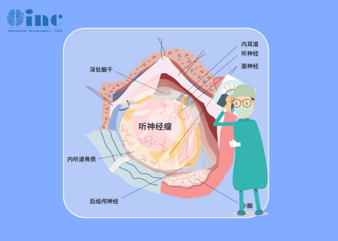 聽神經(jīng)瘤治療理念先于手術(shù)，需要在保面、保聽的先行理念下謹慎進行手術(shù)切除。放眼全球，國外的診療早已將“盡可能全切”、“不面癱”、“保留聽力”三要素作為聽神經(jīng)瘤手術(shù)成功的標準，功能保留逐漸成為治療的首要目標。