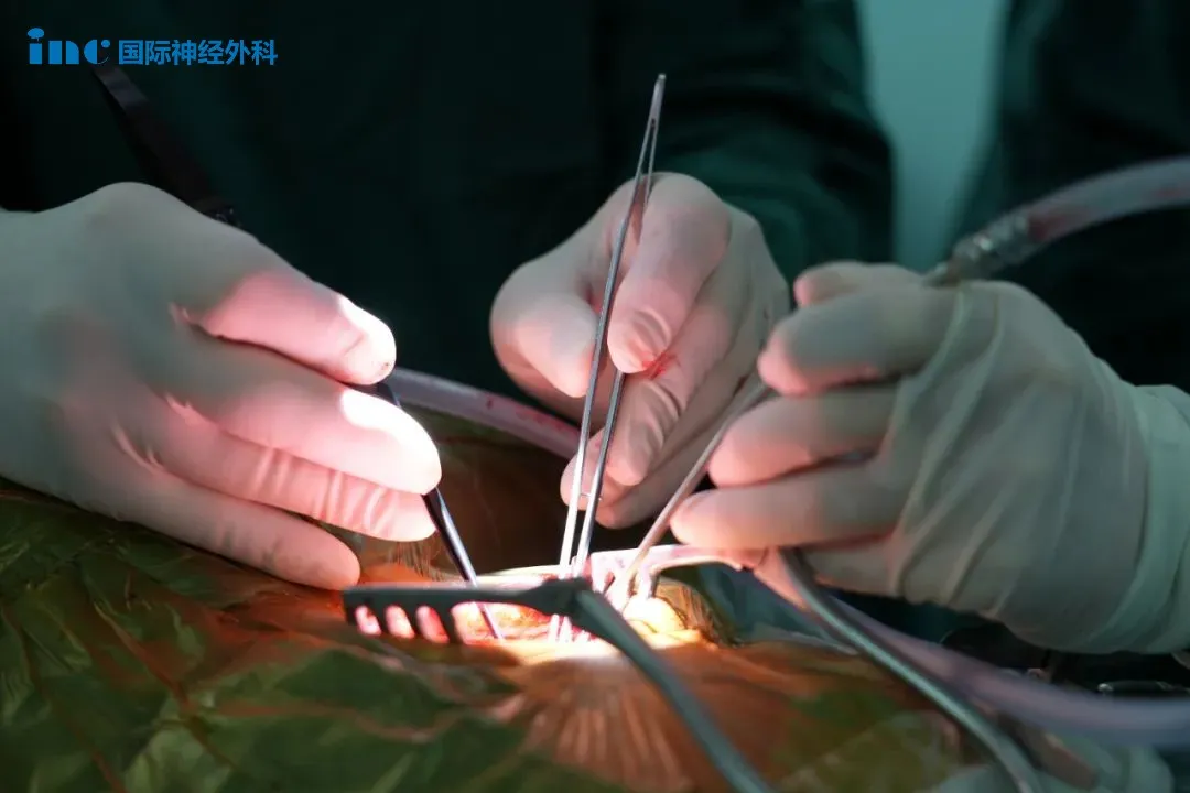 INC巴教授手術(shù)“超感之手”，觸一觸就知腫瘤在哪？