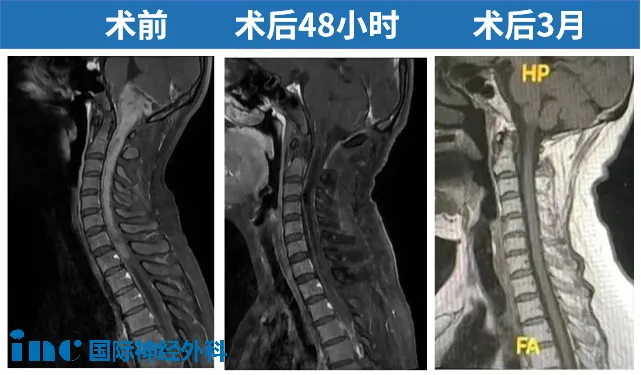 術前術后MRI對比