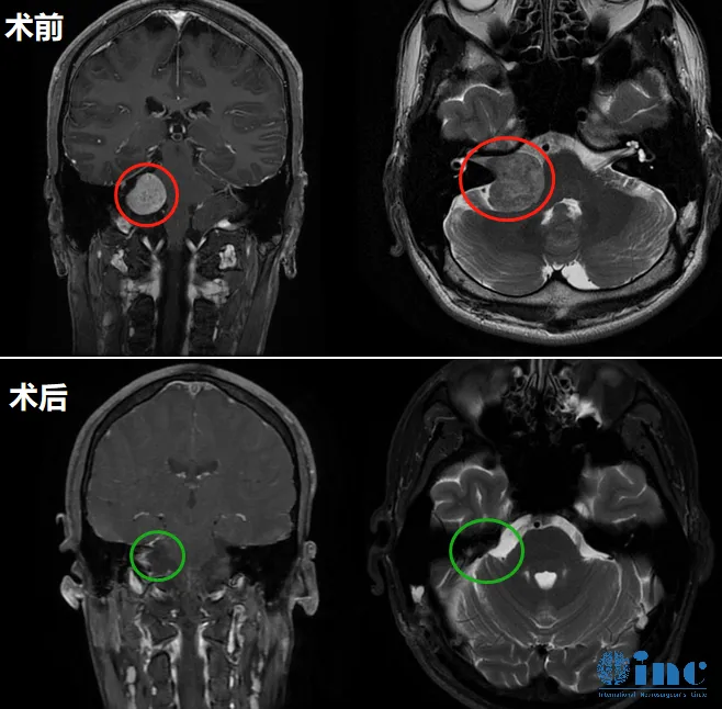全切腫瘤、面聽神經(jīng)解剖保留+功能保留