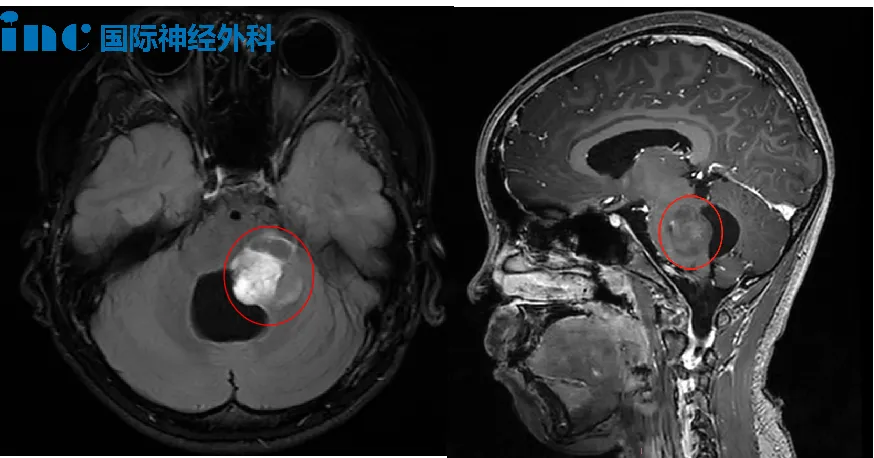 病房 “最重” 腦干膠質(zhì)瘤患兒，開顱術(shù)后快速恢復(fù)