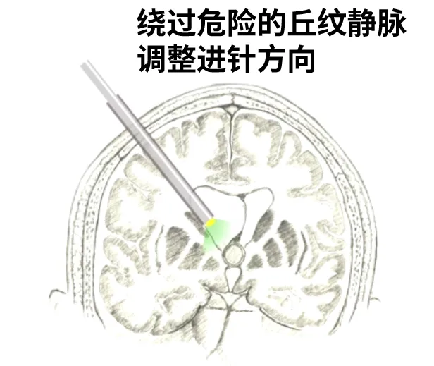 繞過危險得丘紋靜脈調(diào)整進針方向