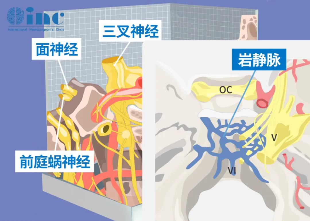 手術(shù)不慎易遺留肢體癱瘓、面癱、聽(tīng)力損傷等