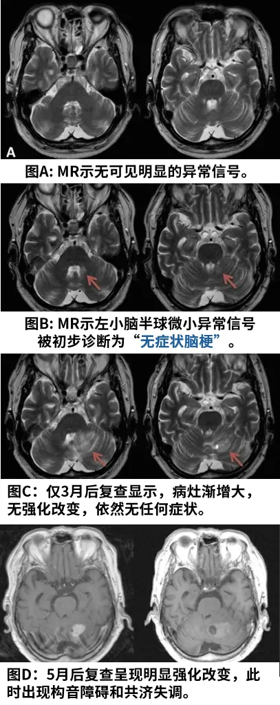 膠質(zhì)瘤案例圖片