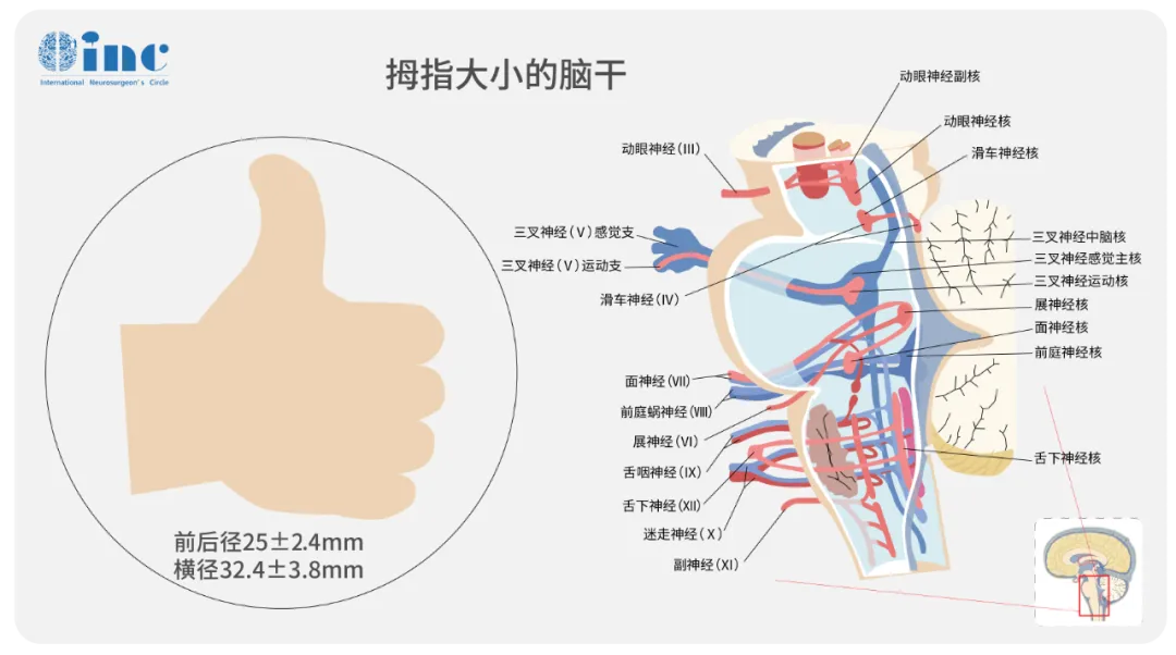 圖：腦干主要包括中腦、腦橋、延髓。位于大腦深處，距離頭皮遠(yuǎn)，手術(shù)入路需要穿過大量正常腦組織、血管、功能區(qū)，其具有難以手術(shù)、手術(shù)風(fēng)險(xiǎn)高。腦干幾乎管轄著生命的一切，如呼吸、心跳、意識(shí)等。相比較大腦其他部位，腦干因其特殊的解剖位置和重要的生理功能，長期以來被稱為“手術(shù)禁區(qū)”。