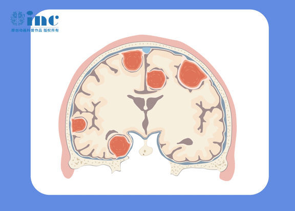 INC手術(shù)紀實：11cm巨大腦膜瘤侵犯顱骨及頭皮的完整切除方案